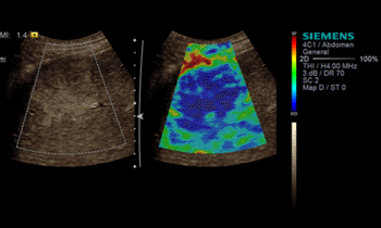 Image: Virtual touch imaging on the ACUSON S3000 ultrasound system (Photo courtesy of Siemens Healthcare). Image: Virtual touch imaging on the ACUSON S3000 ultrasound system (Photo courtesy of Siemens Healthcare).
